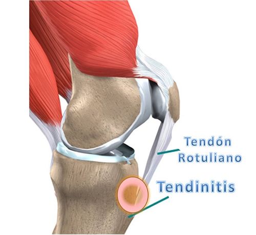 Tendinitis-rotuliana
